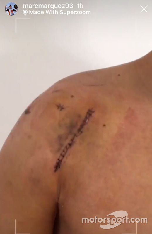 Marc Márquez cicatriz operación hombro izquierdo
